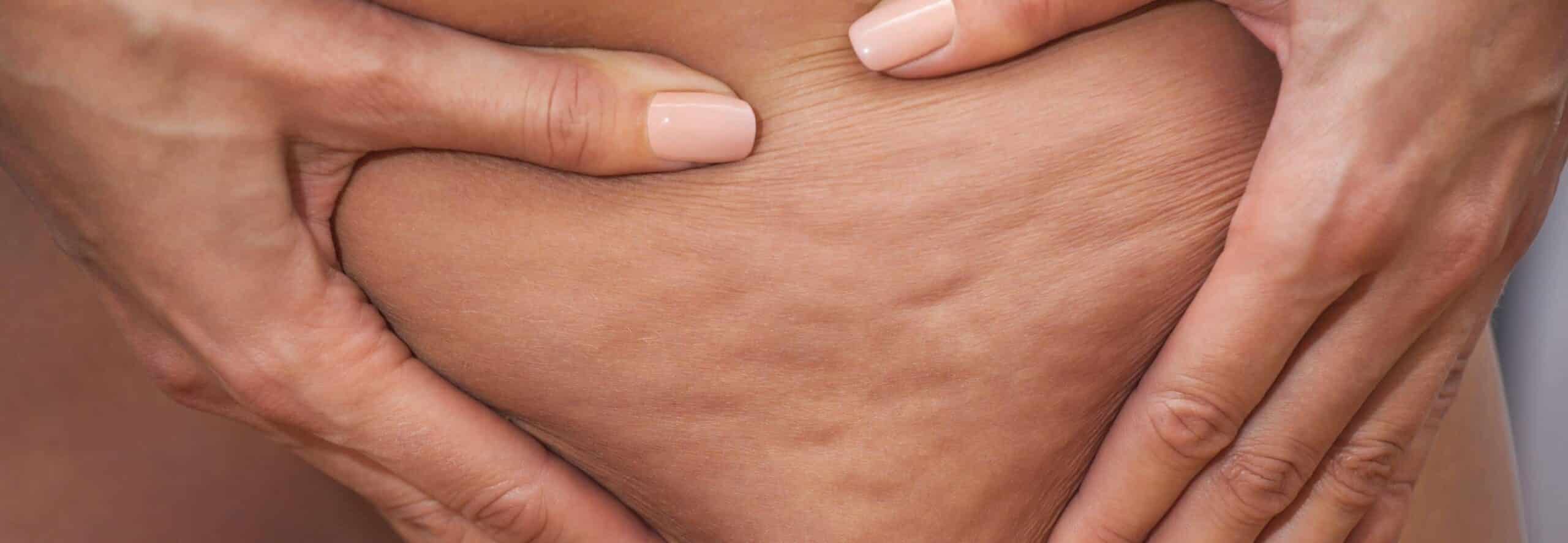 Comment me débarrasser de ma cellulite ? | Dr Rivalier | Lyon