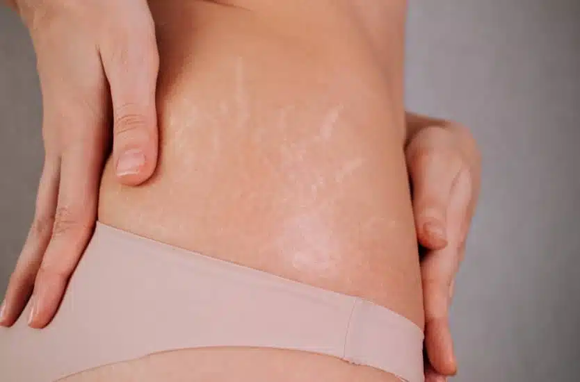 La cryolipolyse aide-t-elle à réduire les vergetures ? | Dr Rivalier | Lyon