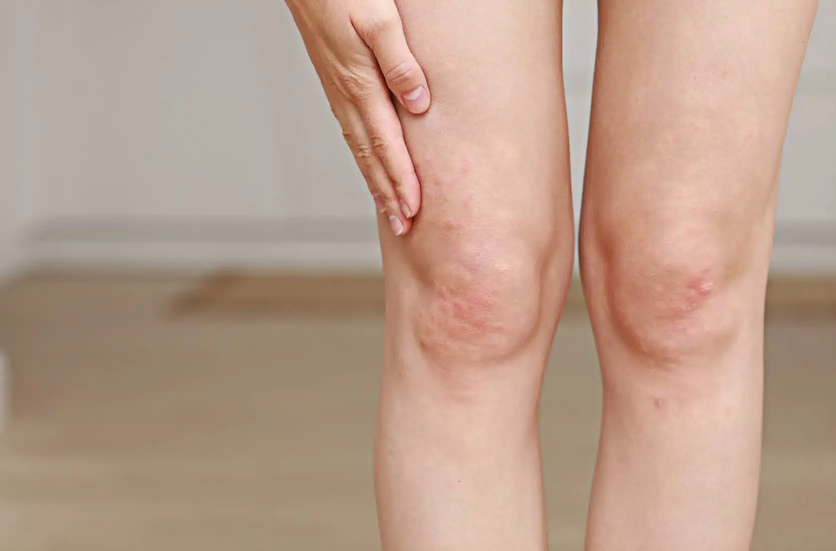 L’épilation laser est-elle compatible avec une peau à tendance atopique ? | Dr Rivalier | Lyon