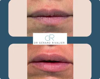 resultats avant et apres acide hyaluronique levres | Dr Rivalier | Lyon