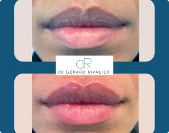 photo avant et apres acide hyaluronique levres | Dr Rivalier | Lyon