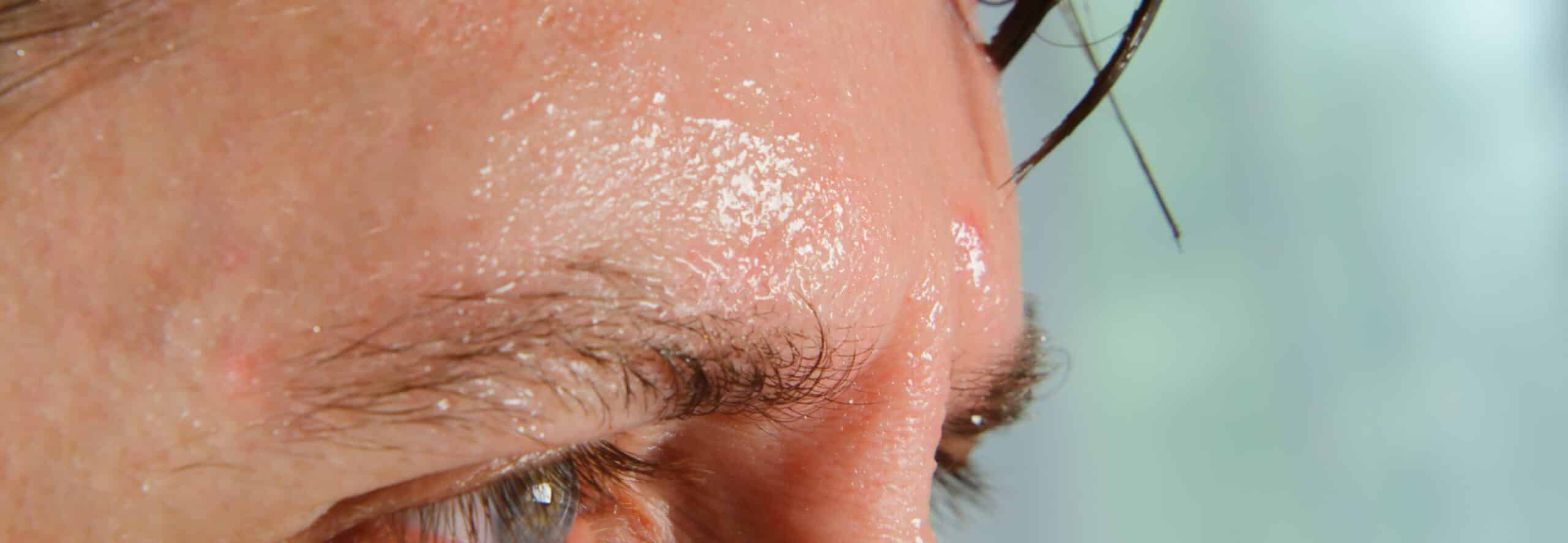Botox medical